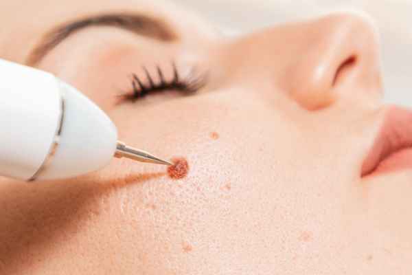 CryoPen: 5 Skin Concerns It May Be Used to Treat 3 What actually happens during a CryoPen treatment Lincolnshire?