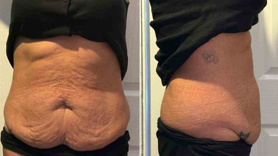 Lost the Weight but Not the Loose Skin? What You Should Know 1 Is It Definitely Loose Skin Lincolnshire?